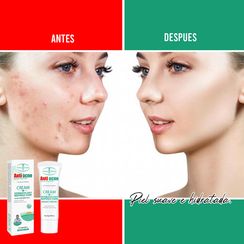 Crema anti acné DERMATOLÓGICA-¡Renueva tu Piel, dile adiós al acné!✨